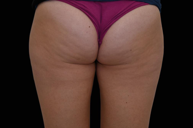 Antes